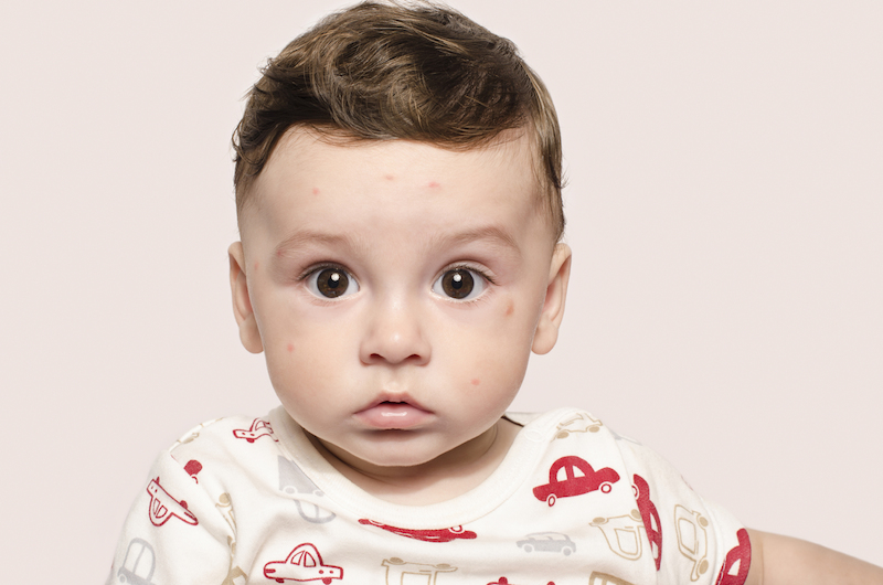 Bambino con eruzione cutanea