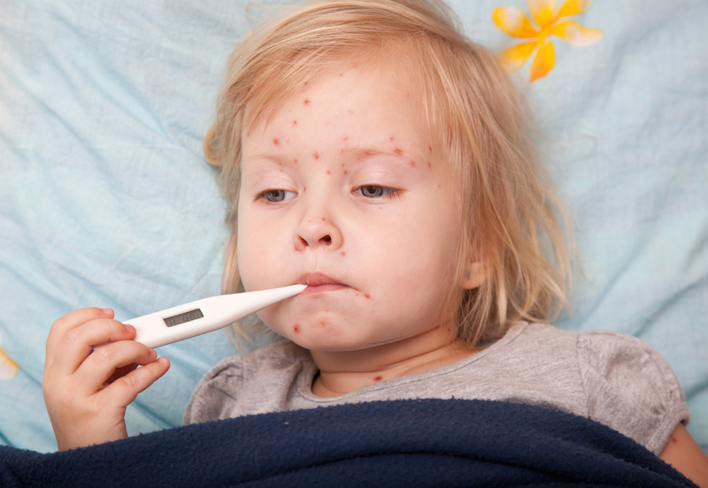 Bambino con varicella